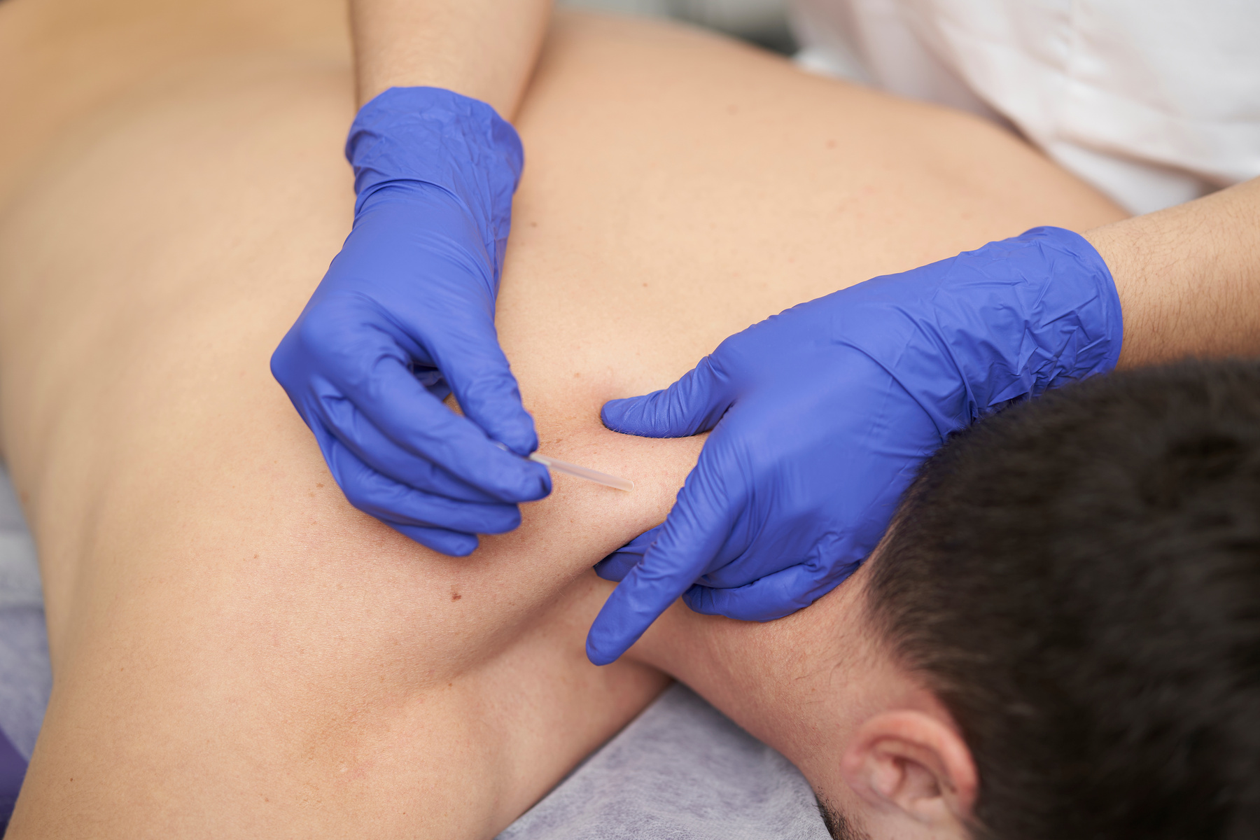 physiotherapist treating an overload with dry needling